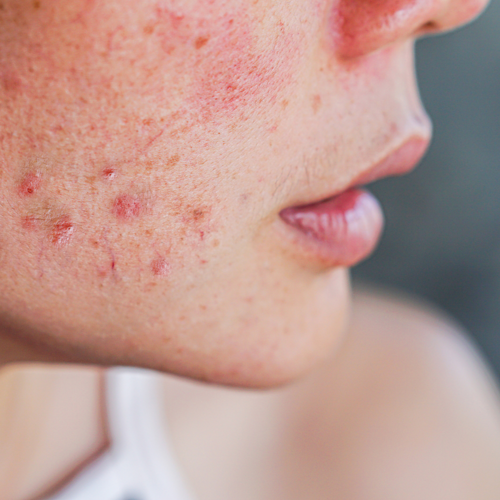 L'acné hormonale : qu'est-ce que c'est ?