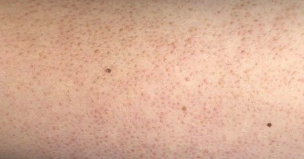 boutons sur les bras kératose pilaire texture rugueuse