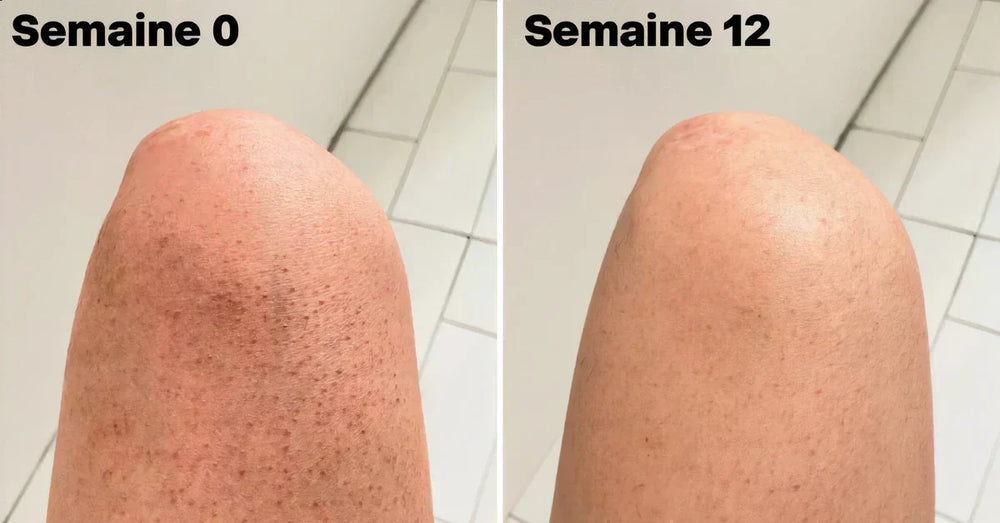 Kératose pilaire avant après traitement : semaine 0 versus semaine 12 avec acide lactique 10%