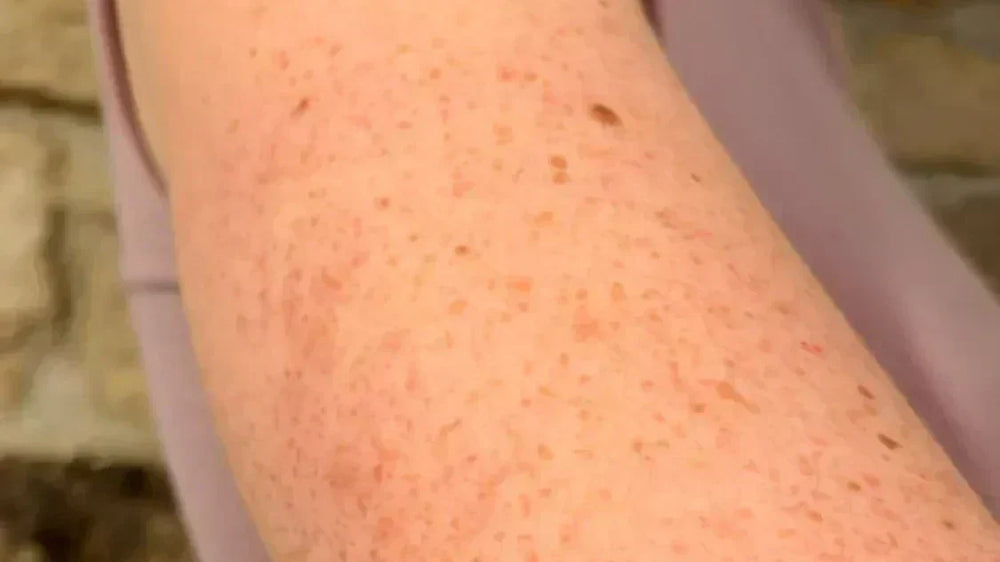 Peau de fraise sur les bras : kératose pilaire, petites bosses rugueuses sur la peau