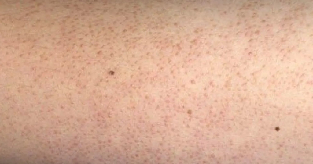 boutons sur les bras kératose pilaire texture rugueuse